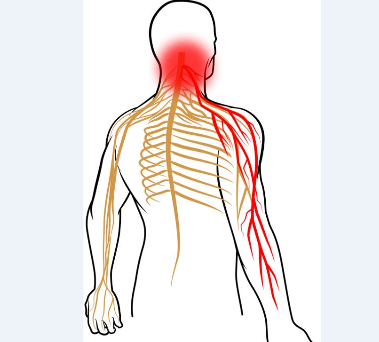 Cervical Radiculopathy (Pinched Nerve in Neck): Symptoms & Treatment